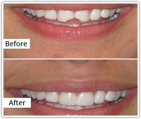 dental bonding recontouring services