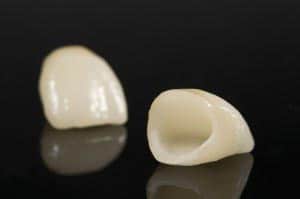 dental onlay 300x199 1