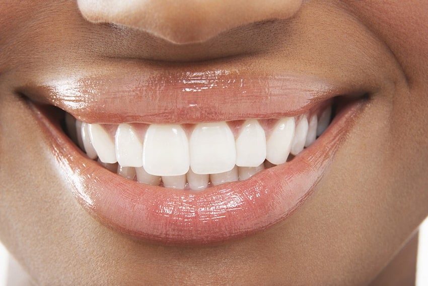 for the love of veneers porcelain veneers treatment 63f3da81c46a9