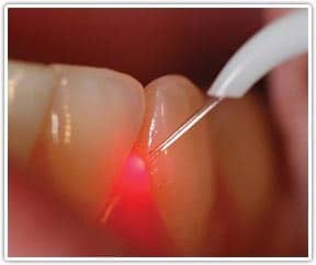 gum lift surgery