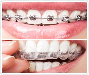 invisalign braces