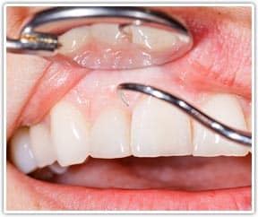 periodontal gum disease treatments