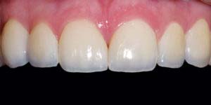 services cs 02 porcelain veneers 02b 300x150 1