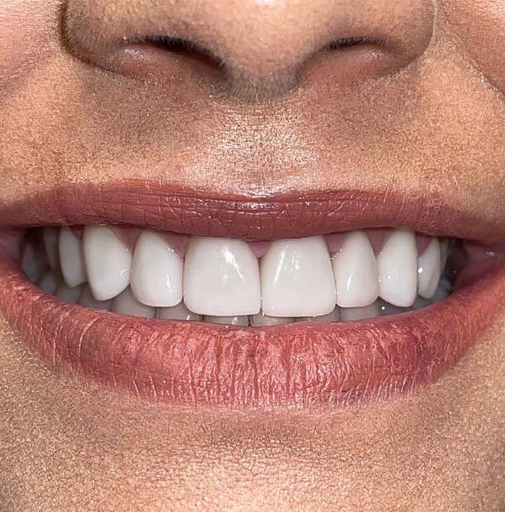After Image: Smile Makeover - front