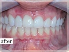 After Image: Smile Makeover - front