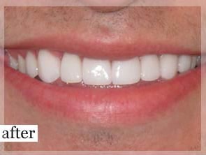 After Image: Smile Makeover - front