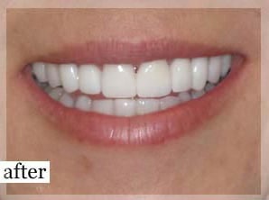 After Image: Smile Makeover - front
