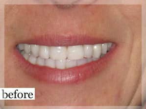 Before Image: Smile Makeover - front