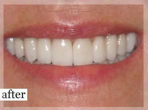 After Image: Smile Makeover - front