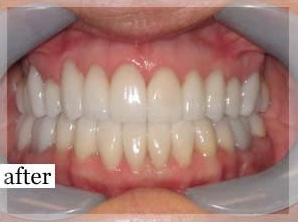 After Image: Smile Makeover - front