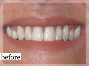 Before Image: Smile Makeover - front