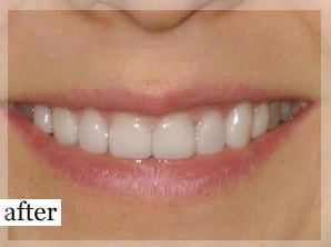 After Image: Smile Makeover - front