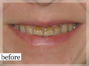 Before Image: Smile Makeover - front