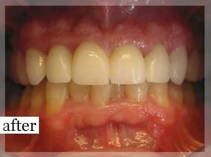 After Image: Smile Makeover - front
