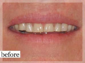 Before Image: Smile Makeover - front