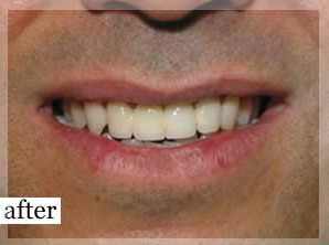 After Image: Smile Makeover - front