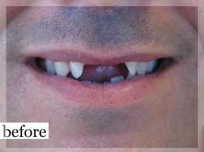 Before Image: Smile Makeover - front