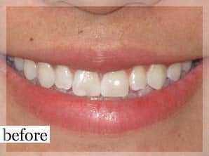 Before Image: Smile Makeover - front