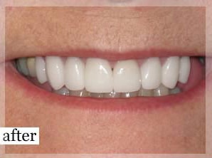 After Image: Smile Makeover - front