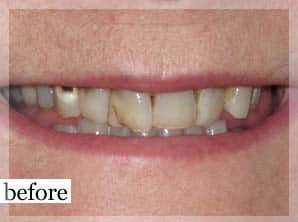 Before Image: Smile Makeover - front