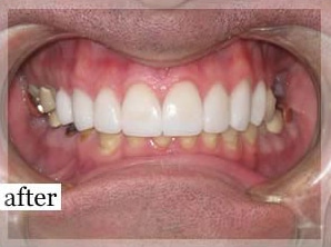 After Image: Smile Makeover - front
