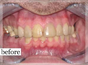 Before Image: Smile Makeover - front