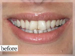 Before Image: Smile Makeover - front
