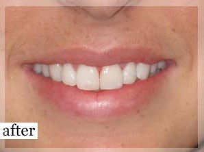 After Image: Smile Makeover - front