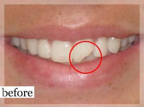 Before Image: Smile Makeover - front