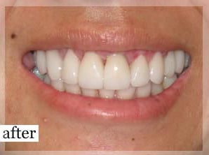 After Image: Smile Makeover - front