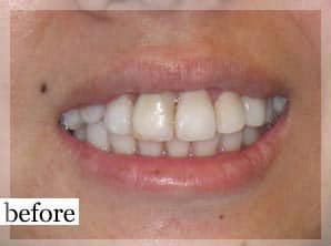Before Image: Smile Makeover - front