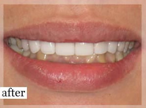 After Image: Smile Makeover - front