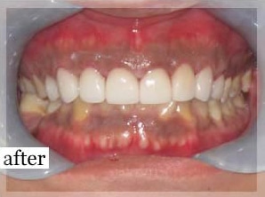 After Image: Smile Makeover - front