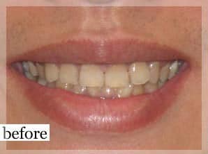 Before Image: Smile Makeover - front