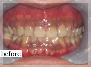 Before Image: Smile Makeover - front