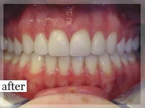 After Image: Smile Makeover - front