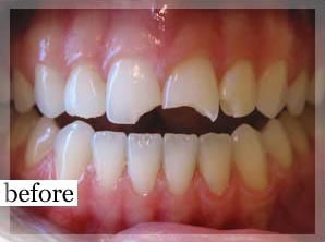 Before Image: Smile Makeover - front
