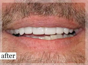 After Image: Smile Makeover - front
