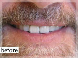 Before Image: Smile Makeover - front