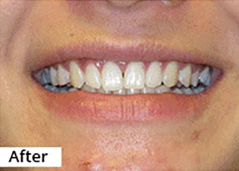 After Image: Smile Makeover - front