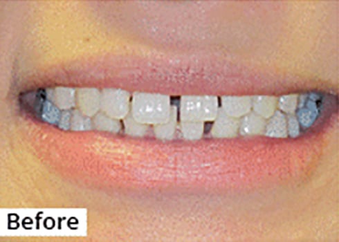Before Image: Smile Makeover - front