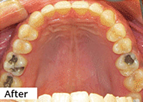 After Image: Smile Makeover - front