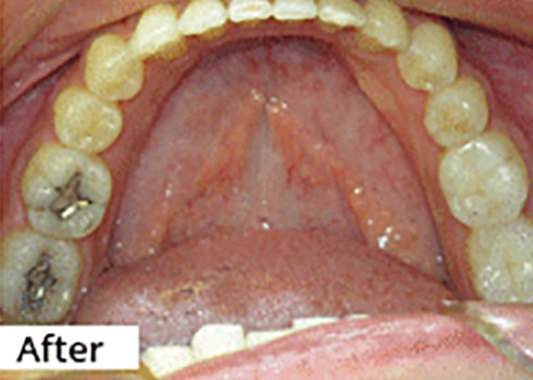 After Image: Smile Makeover - front
