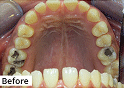 Before Image: Smile Makeover - front