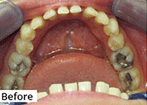 Before Image: Smile Makeover - front