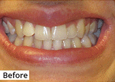 Before Image: Smile Makeover - front