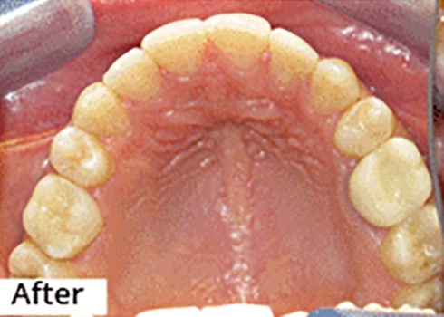 After Image: Smile Makeover - front