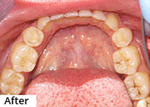 After Image: Smile Makeover - front