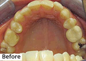 Before Image: Smile Makeover