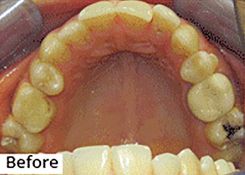 Before Image: Smile Makeover - front